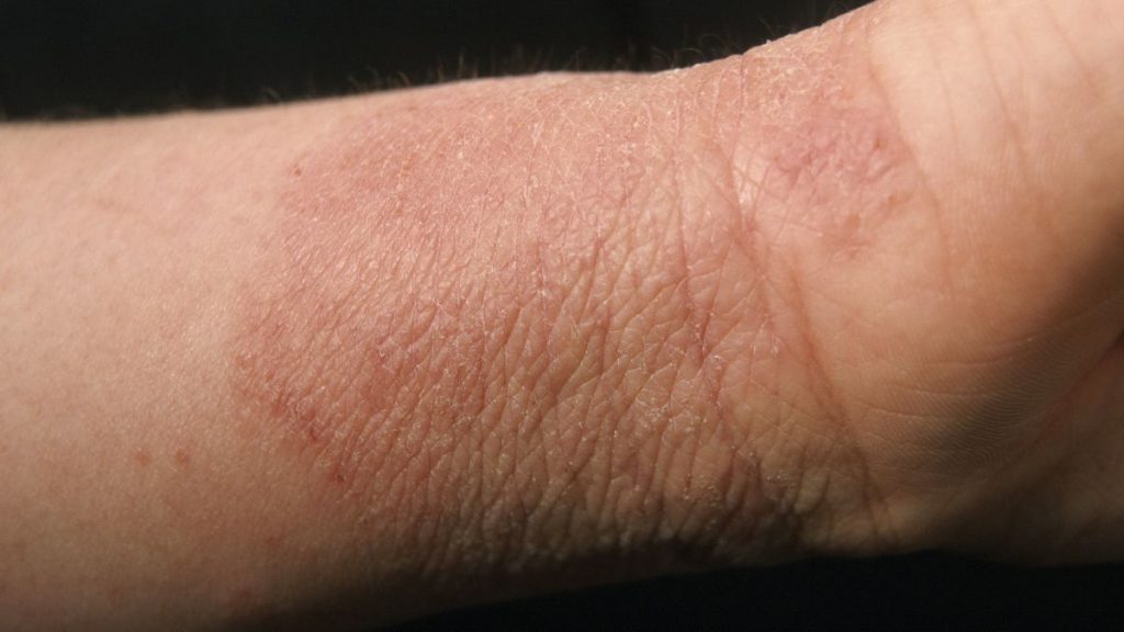 discoid eczema treatment